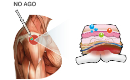 Terapia articolare con Veicolazione transdermica di acido jaluronico Fase 1