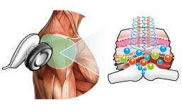 Terapia articolare con Veicolazione transdermica di acido jaluronico Fase 2